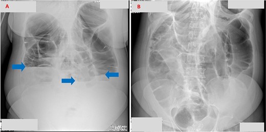 (A) Erect abdominal X-ray demonstrating multiple air–fluid levels (arrows). (B) Supine abdominal X-ray showing dilated bowel loops, suggestive of intestinal obstruction.