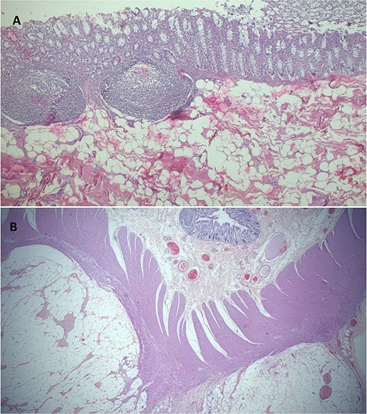 (A) Histopathology demonstrating normal colonic mucosa, submucosa demonstrates a mesenchymal lesion comprised of matured fat cells (H&E staining at 40× original magnification). (B) Photomicroscopy highlighting a benign, well circumscribed colonic lipomatous tumor dissecting muscularis propria muscles (H&E staining at 20× original magnification).
