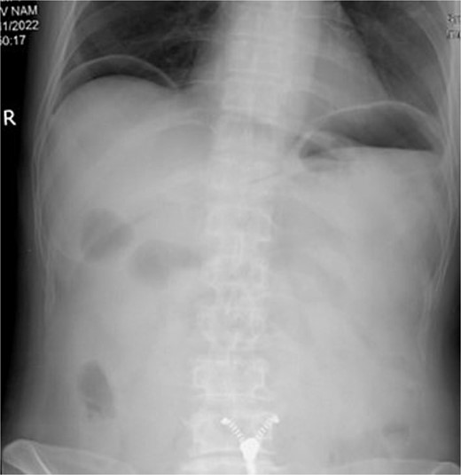 X-ray showing free air under both hemi-diaphragms, indicative of gastrointestinal perforation.