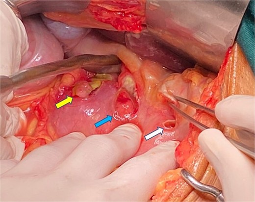 Intraoperative photograph demonstrating triple gastric perforations (yellow, blue, and white arrows indicate the locations of the perforations).