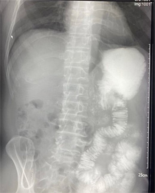 Postoperative barium gastrography revealing good flow at the gastrojejunal anastomosis.