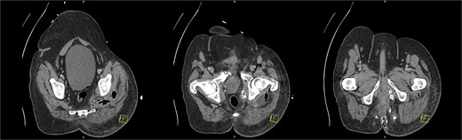 CT pelvis (axial slices) demonstrating the perianal surgical site with packing, and the gas and fluid containing intergluteal collection.