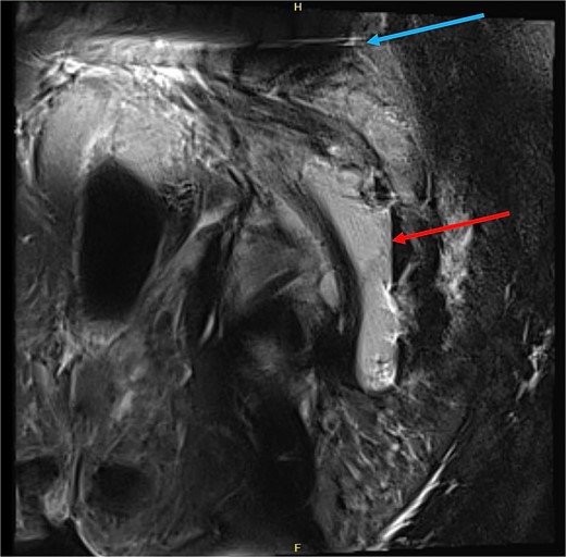 MRI pelvis (sagittal slice, patient lying lateral) demonstrating air-fluid level within the intermuscular abscess (red arrow), and artefact from SIJ screws (blue arrow).