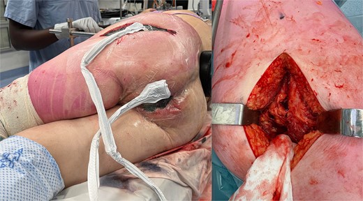 Clinical photographs of the patient’s VAC dressings (left) and the posterior approach to the hip with the exposed sciatic nerve (right).