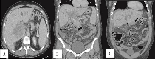 Contrast-enhanced CT scan of the abdomen and pelvis in (A) axial and (B, C) coronal sections obtained at the porto-venous phase showing a hypo-vascular geographic area with complex fluid density at the hilum of the liver with intrahepatic biliary dilatation. Non-opacification of the main portal vein with early cavernous transformation was noted as well as mild splenomegaly and ascites.
