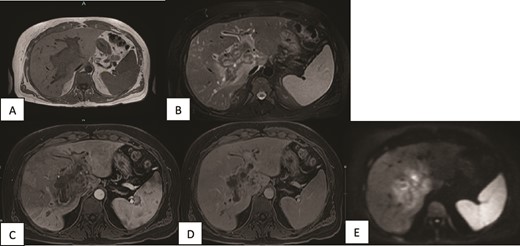 MRI of the liver (A, B) Axial T1WI and T2WI fat-saturated images revealing an isointense central rim with hypointense periportal edema on T1-weighted images and a hypointense rim along the portal tracts with periportal edema on T2-weighted images. (C, D) Axial T1WI postcontrast images obtained at the arterial and porto-venous phases showing mild peripheral enhancement with non-enhancement of the portal vein. (E) DWI showing minimal diffusion restriction at the hilum.
