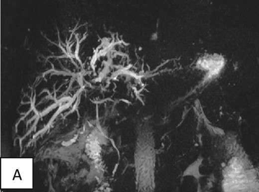 Magnetic resonance cholangiopancreatography of the liver showing dilated intrahepatic biliary radicals. Normal insertion and caliber of both cystic and common bile duct with no filling defects or irregularity to suggest impacted stones or peripheral strictures.