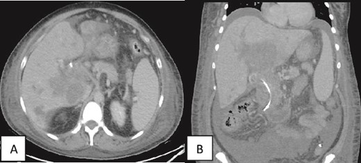 (A, B) Contrast enhanced CT scan of the abdomen and pelvis in axial and coronal sections in porto-venous phase status post-stenting showing that the hypo-vascular hypodense areas progressed compared to the initial CT with involvement of the liver parenchyma and hepatic hilum. Associated intrahepatic biliary ductal dilation and evidence of increased ascites was also noted. A pig-tail catheter tip is seen in the left lower quadrant.