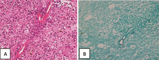 Histopathology of the liver core biopsy. (A) Inflamed necrotic/infarcted liver parenchymal tissue almost totally replaced by severe diffuse eosinophilic inflammatory infiltrates with Splendore–Hoeppli structures, Charcot Leyden crystals, hemorrhage, edema and fibrosis consistent with a hepatic abscess. Hematoxylin and eosin section ×400. (B) GMS special stain reveals large broad variably sized mostly aseptate thin-walled fungal hyphae with branching morphologically consistent with zygomycotic fungal hyphae ×400.