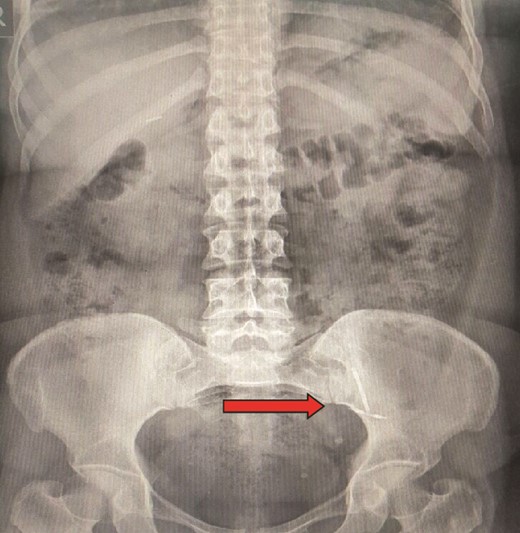 Abdominal radiograph showing presence of a foreign body in the left lower abdomen.