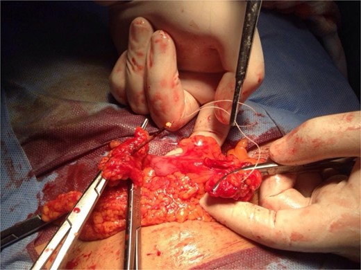 Intraoperative clinical image of IUCD seen to be perforating the sigmoid colon.