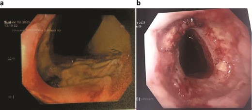 Patient One: (a) Before VACStent insertion, showing the oesophageal defect. (b) After VACStent treatment, demonstrating successful defect closure.