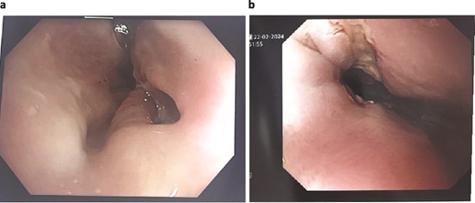 Patient Two: (a) Before VACStent insertion, showing the oesophageal defect. (b) After VACStent treatment, demonstrating successful defect closure.
