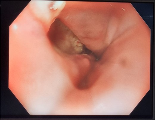 Patient Three: Before VACStent insertion, showing the oesophageal defect.