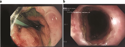 Patient Four: (a) Before VACStent insertion, showing the oesophageal defect. (b) After VACStent treatment, demonstrating successful defect closure.