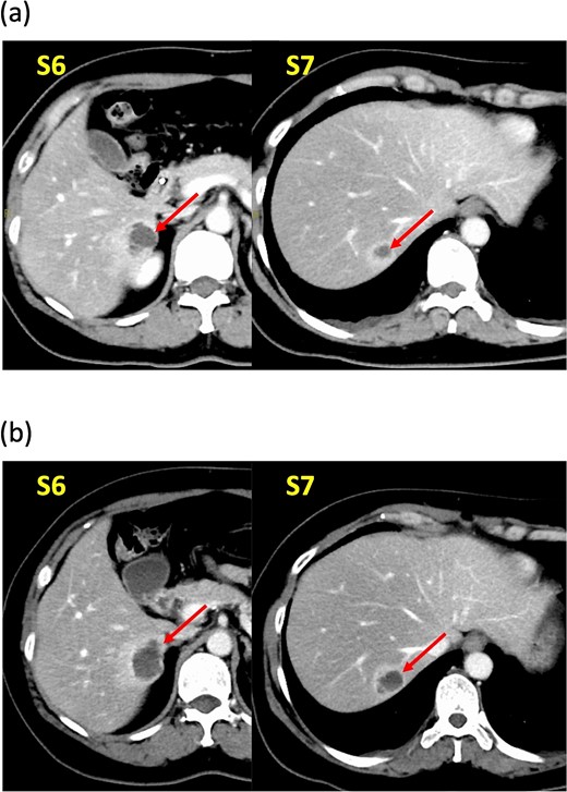 Dynamic computed tomography (CT) findings. (a) Two years ago, cystic tumors were detected as low-density lesions surrounded by contrasting tissue in segments 6 (S6) and 7 (S7). (b) Preoperative CT shows both tumors had enlarged slightly.
