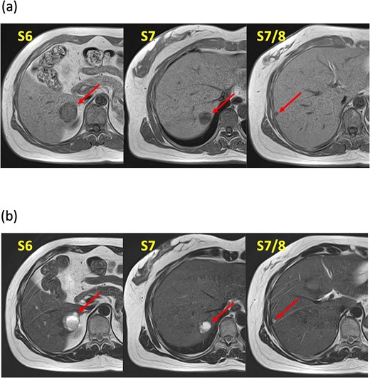 Magnetic resonance imaging findings. Known tumors are visible in S6, S7, and an additional tumor is found at the S7/8 boundary. These tumors appeared as low-intensity lesions on (a) T1-weighted images and (b) high-intensity lesions on T2-weighted images.