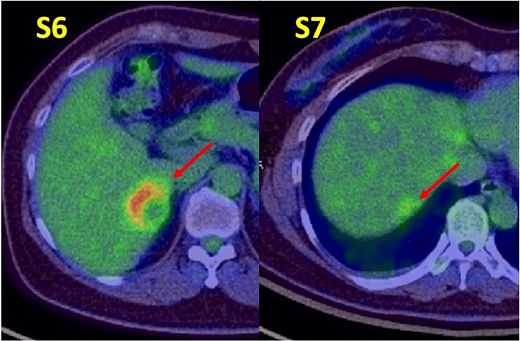 Positron emission tomography-computed tomography findings. Abnormal tracer accumulation are observed in the S6 and S7 tumors.