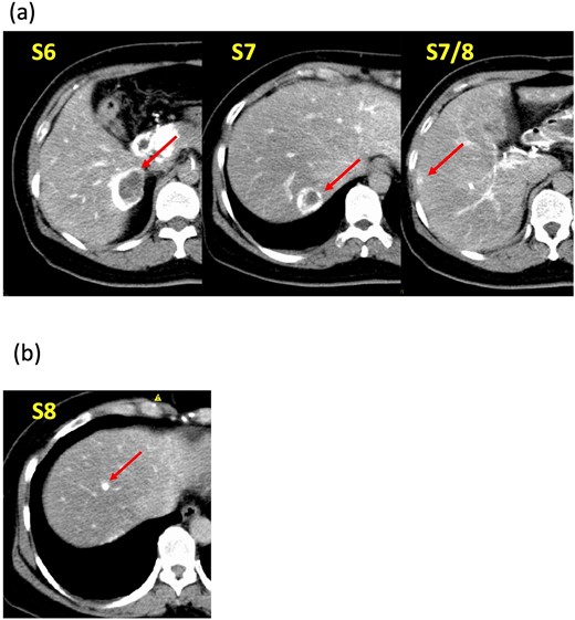 Computed tomography during hepatic arteriography findings. (a) Known tumors in S6, S7, and S7/8 exhibit peripheral contrast enhancement but lack contrast in their centers. (b) The new tumor in S8 displays a distinct, uniform contrast effect.