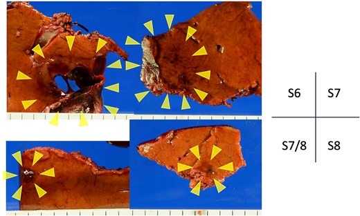 Resected gross specimens. All tumors with brownish areas are indicated by yellow arrows. Tumor in S6 with cavities.