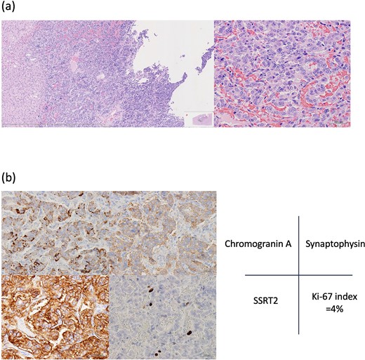 Histopathological findings. (a) Hematoxylin–eosin staining shows pleomorphic nuclei and dense chromatin in tumor cells, as well as cyst-like structures likely formed by exfoliated tumor cells. (b) Immunopathological examination: Tumor cells are positive for chromogranin A, synaptophysin, somatostatin receptor type 2 (SSRT2). Ki-67 is positive in 4% of tumor cells.