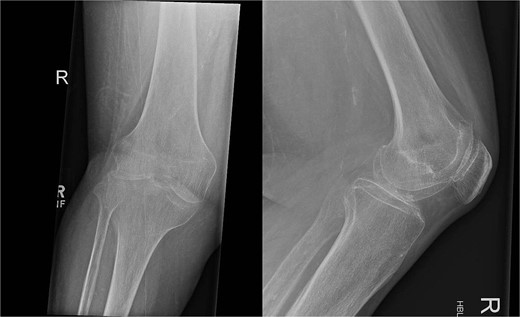 Pre-operative AP and lateral X-rays of the knee.