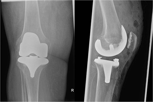 Post-operative AP and lateral X-rays of the knee.