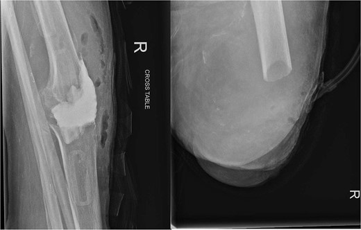 On the left X-ray of the knee after removal of prosthesis and insertion of antibiotic-impregnated cement spacer and on the right X-ray of the stump following amputation.