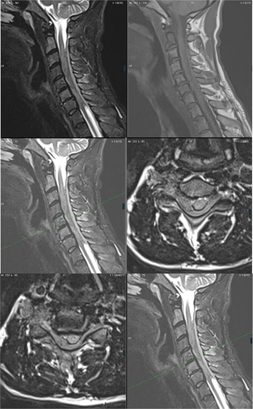MRI non-contrast.