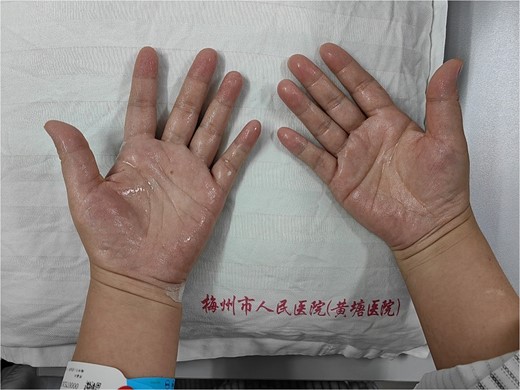 Patient’s sweaty palms.