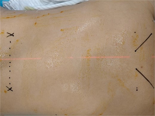 T4, L3 puncture entry point localization.