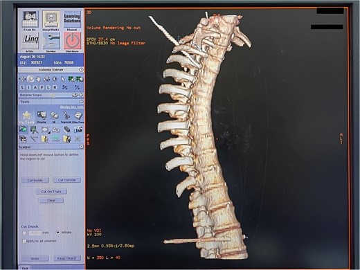 Three-dimensional reconstruction of a successful thoracic and lumbar sympathetic ganglion puncture.
