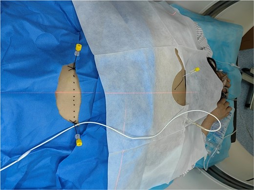 1–2 cycles of radiofrequency thermocoagulation of thoracic and lumbar sympathetic nerves.