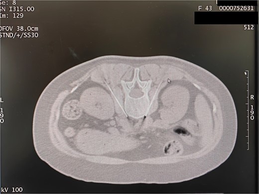 Lumbar sympathetic chain puncture path design.