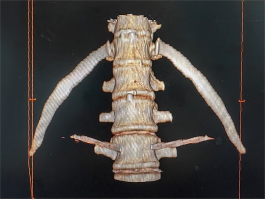 Three-dimensional reconstruction of a successful lumbar sympathetic ganglion puncture.