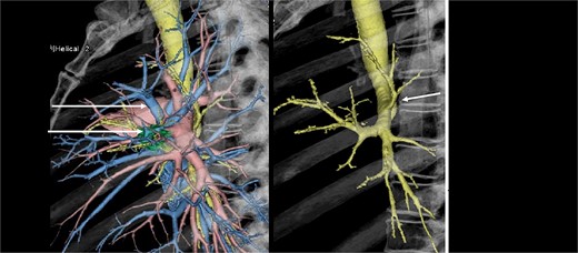 Preoperative three-dimensional contrast-enhanced computed tomographies (3DCT) showed a displaced anomalous B1+2 bronchus arising from left main bronchus, which ascends behind the main pulmonary artery.