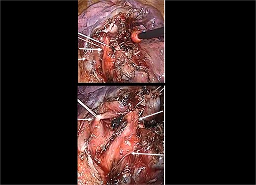 Intraoperative image showing the B3 plus lingular bronchus. Owing to the understanding of the relative anatomy of arteries, veins, and bronchi, posterior fissure making was not necessary. Br, bronchus; PV, pulmonary vein.