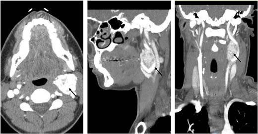 Coronal, sagittal, and axial images showing the 3.6 × 3.5 cm mass splaying the left internal and left external carotid arteries.