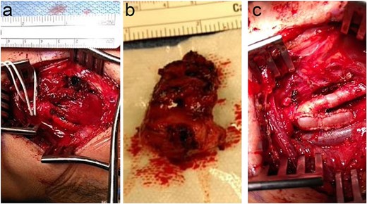 (a) Left neck exposure showing the adhered carotid body tumor. (b) Once the tumor was excised. (c) After patch angioplasty occurred.