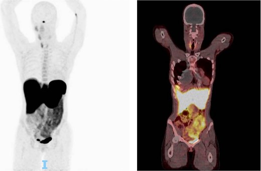 One hour after 5.4 millicurie of fludeoxyglucose injected this shows a CT scan followed up by PET scan. No suspicious focal activity was noted. Physiologic activity was noted in the right parotid/salivary glands minimally on the left mandibular gland, and bilateral thyroid, more on the right thyroid. Otherwise, no abnormal uptake was noted in the left neck. Presumed postop changes were seen in the left neck.