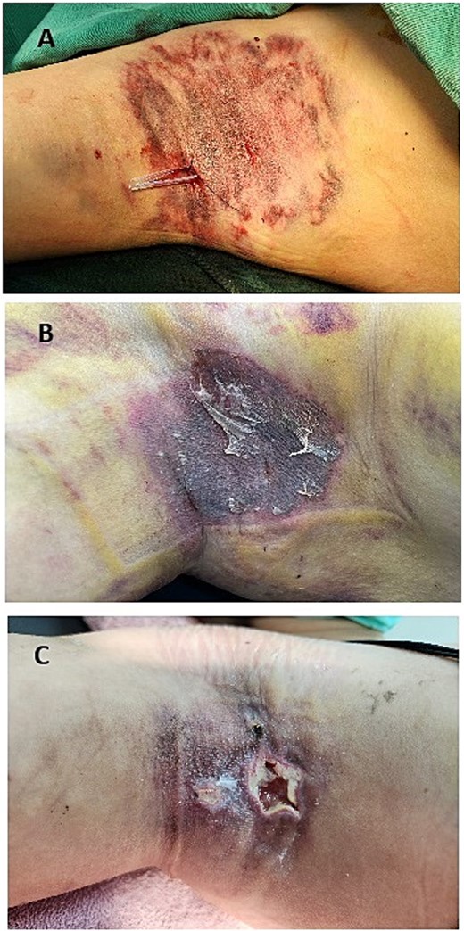 (A) Postoperative image showing the placement of a Penrose drain in the right axilla after hematoma evacuation. The drain is used to facilitate the removal of residual blood and prevent fluid accumulation, promoting proper flap healing. (B) Image taken on the sixth postoperative day, 3 days after the removal of the Penrose drain on the third day. The dressing is clean with no signs of hematoma or active bleeding. The flap appears intact, with no visible complications at this stage. (C) Image taken 3 weeks postoperatively, showing significant necrosis of the flap.