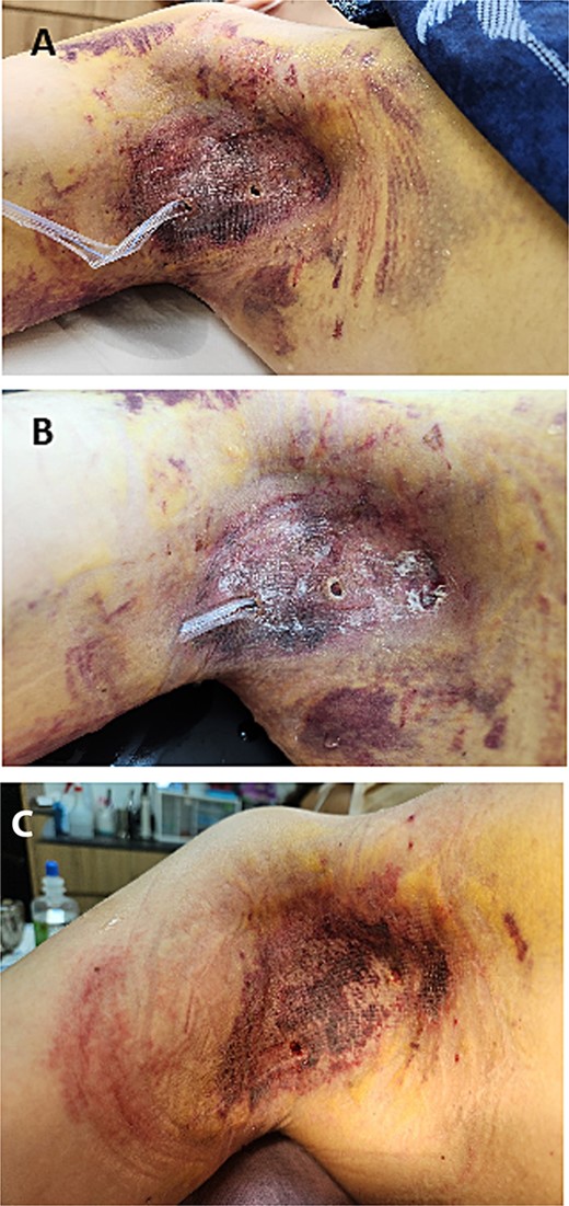 (A) Postoperative image of the right axilla on the third postoperative day, showing the Penrose drain in place with minimal drainage observed. The flap appears intact, with no signs of complications or hematoma. (B) Postoperative image on the sixth postoperative day, where a Penrose drain is reintroduced as a proactive measure to address concerns of delayed hematoma liquefaction. The drainage volume is carefully monitored for any indications of liquefied blood. (C) Postoperative image taken 4 weeks after surgery, showing that the flap has survived without any hematoma formation. The skin appears well-healed, with no signs of complications or necrosis.