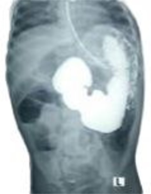 Selected cut of an upper gastrointestinal contrast study showing dilated and elongated stomach, dilated first and second part of the duodenum, delayed passage of the contrast, and scanty gas in the distal abdomen keeping with features of chronic partial duodenal obstruction.