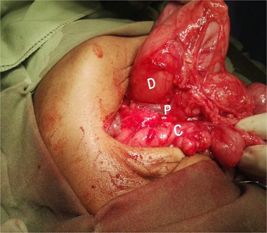 Intraoperative picture showing the PDPV crossing over the duodenum and causing duodenal obstruction. C, colon; D, duodenum; P, preduodenal portal vein.