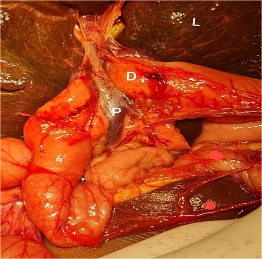 Interpretive view of biliary atresia case showing a PDPV crossing the second part of the dedendum. D, dedendum; L, liver; P, preduodenal portal vein.