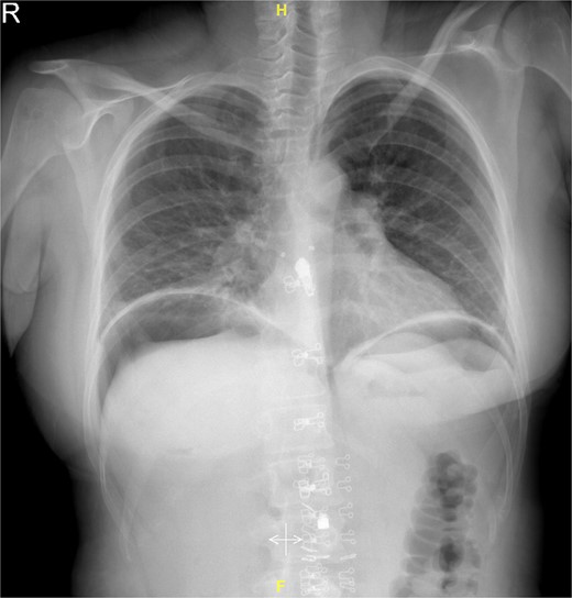 Air under diaphragm on an erect chest X-ray.