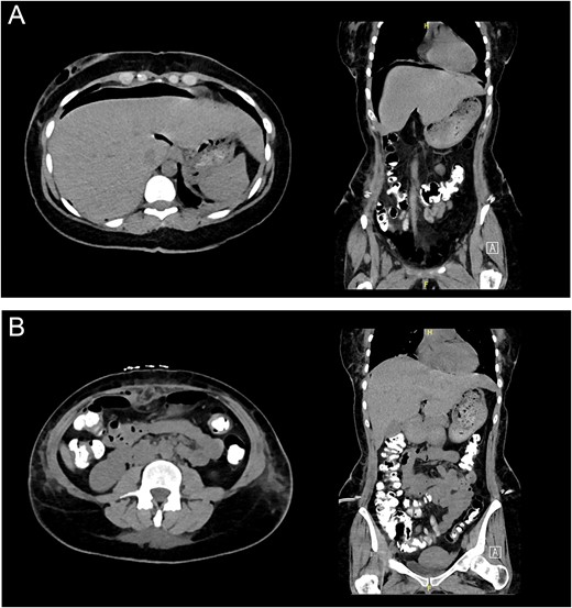 (A) Abdominal CT demonstrating subphrenic pneumoperitoneum. (B) Abdominal CT with triple contrast without any contrast extravasation.