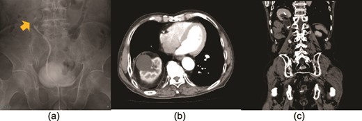 The yellow arrow in the retrograde pyelography shows a ureteral tumor in the upper ureter (a). There were no findings suggestive of metastases, and the clinical diagnosis was right ureteral carcinoma T2N0M0. An axial (b) and coronal (c) computed tomography view show the right kidney in the thorax with protrusion of the diaphragm, suggesting a thoracic kidney.
