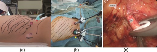 Port position at the beginning of retroperitoneal laparoscopic surgery (a). indicates the port for the camera, ◯ refers to the 12 mm left and right ports for manipulation, and □ is the 5 mm port site for the assistant. (b, c) Manipulation of renal vessels was complex because the forceps could not reach the suprahilar area through the lateral ports (☆). Dotted lines indicate the ribs. RA: renal artery.