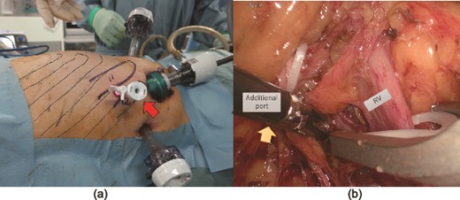 (a) A 5 mm port added at the intercostal site (arrow). Dotted lines indicate the ribs. (b) The additional intercostal port secured access to the supra hilar area (arrow), allowing for safe renal vascular control and manipulation of the superior aspect of the kidney. RV: renal vein.